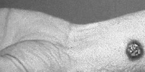 Gastrointestinal Anthrax Images