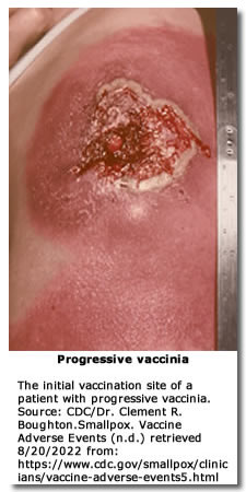  is one of the most severe complications of smallpox vaccination.