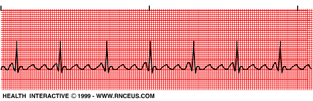 Normal Ecg Strip