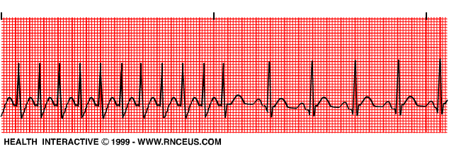 ekg+strips