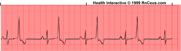 Atrial fibrillation strip some crazy