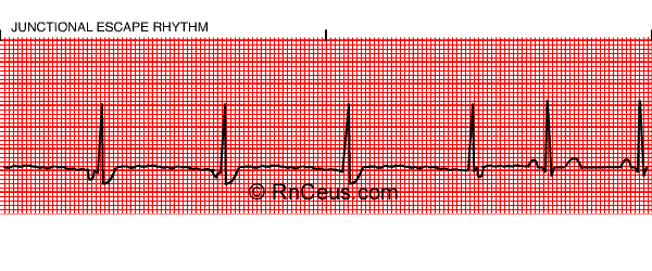 treatments for junctional escape rhythm treatments for junctional escape rhythm