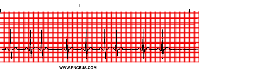 Premature Atrial Contractions Premature Atrial Contractions