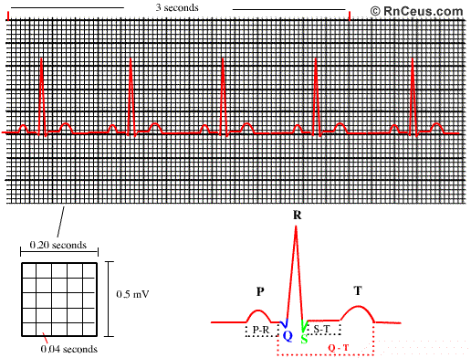 Telemetry Heart Rate Chart