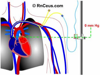 Central Venous Pressure
